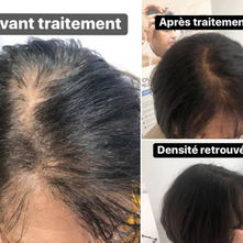 Alopécie androgénique : tout comprendre et les solutions qui fonctionnent vraiment