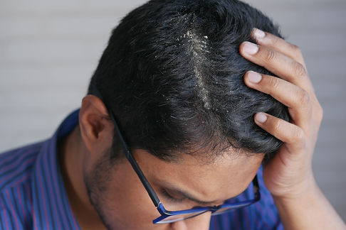 men-with-dandruff-in-his-hair-closeup.jpg
