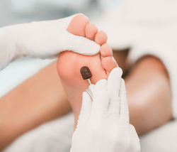 Amincissement de la corne