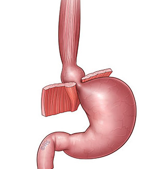 hiatus hernia / sliding hernia
