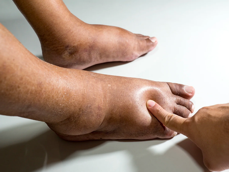 swollen feet
