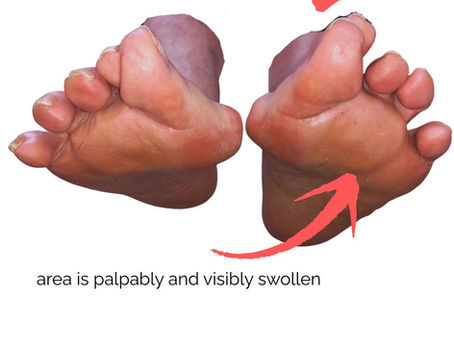 plantar plate tear