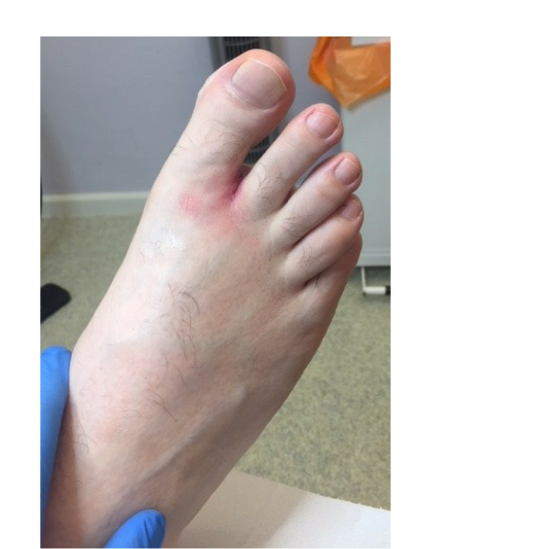 Pyogenic Foot Infection RECOGNISING INFECTION