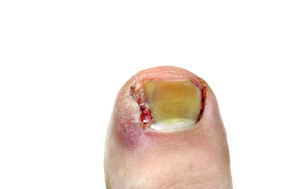 a red, sore, oozing, smelly, unsightly ingrowing toenail.... this can be a thing of the past!