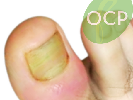 Home Remedies for Retronychia: Say Goodbye to that Sore Toe!