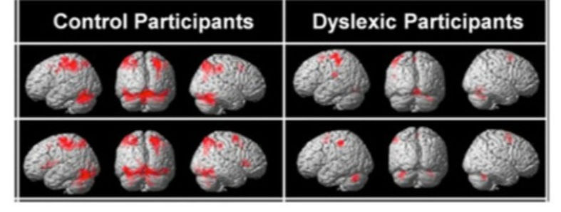 Differences in brain activity with dyslexia