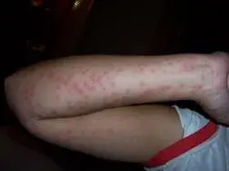 what-do-bed-bug-bites-look-like.webp