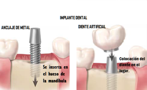 Partes de un implante