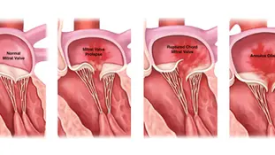 Mitral kapak prolapsusu
