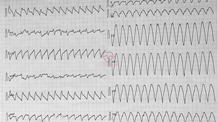 Ventriküler taşikardi (VT)