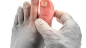 Gut ve hiperürisemi