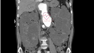 Polikistik böbrek hastalığı