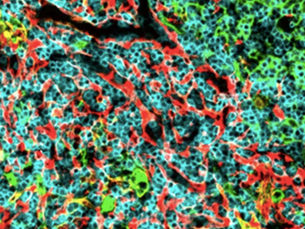 Identifican moléculas del organismo que podrían frenar una leucemia muy agresiva