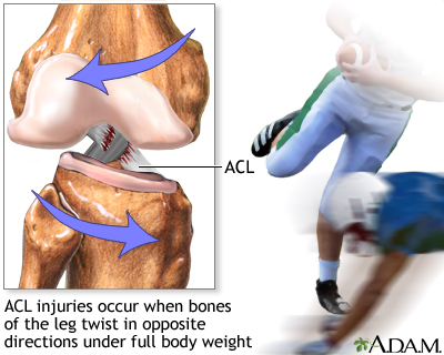ACL Tear which attaches from the posterior of the femur to the anterior tibia