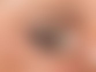 Catarata: saiba tudo seus tratamentos.