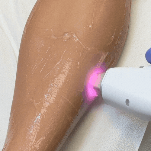 170medspa-170-laser.gif