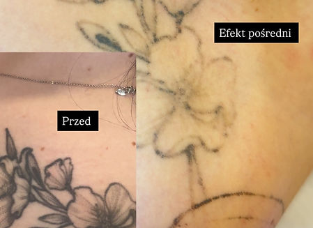 laserowe usuwanie tatuazu