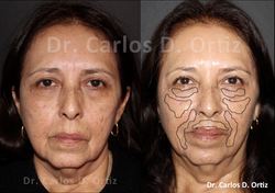 Pre-Post aplicación 1 mes