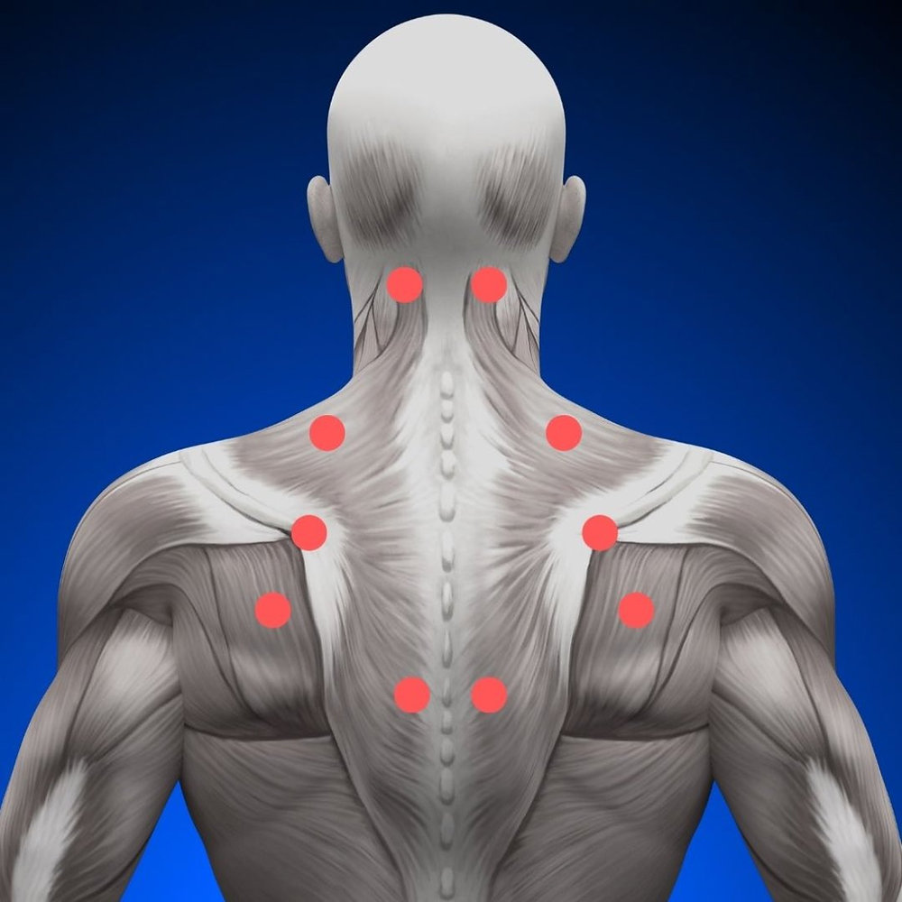Muscel Trigger Point Understanding Trigger Points in Muscles: Treatment Options and ...