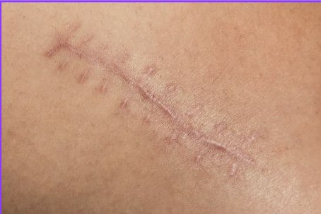 RESTORE scar therapy