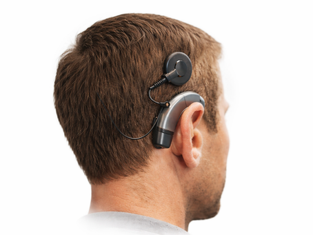 Perguntas frequentes sobre Implante Coclear