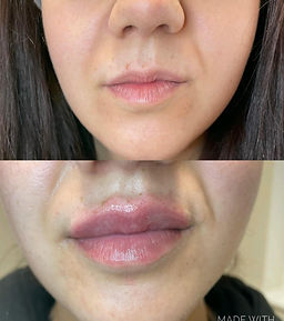 Lip flip, Lip fillers