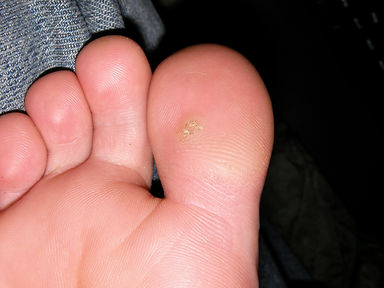 Toe_plantar_wart_0147.jpeg