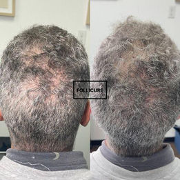 Before and after picture showing hair regrowth on a mans maie patteren bauld spot after Follicure HSR hair restoration treatment in Windsor Ont