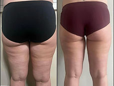 Visual results of inkless skin revision on thigh stretch marks, improving skin elasticity and texture