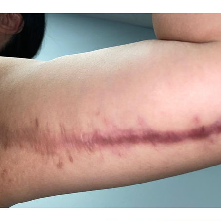 large surgical scar on an under arm