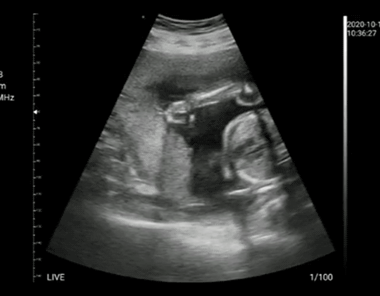 17-fetus