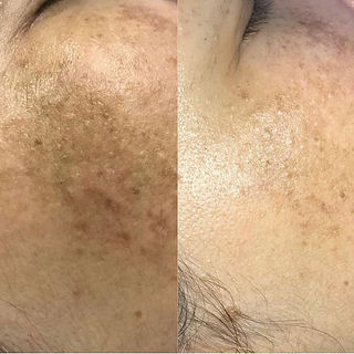 BioRePeelC13 on melasma and hyperpigmentation