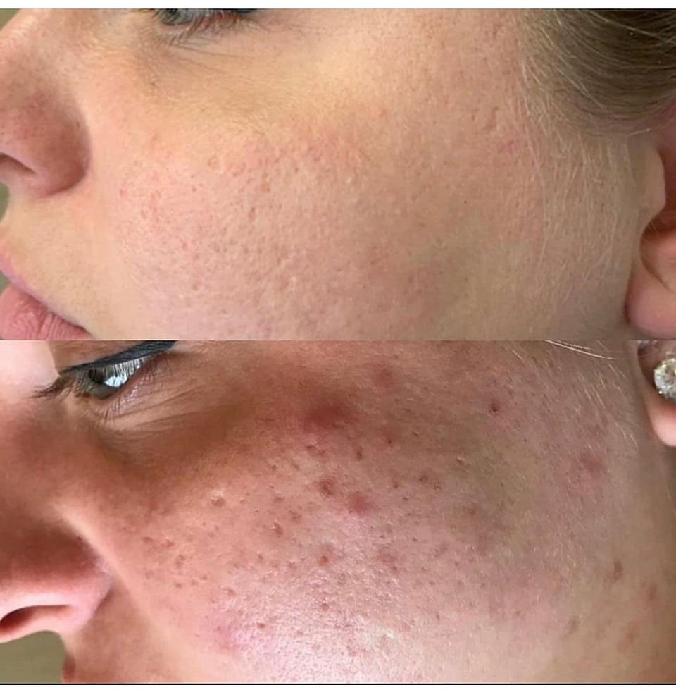BioRePeel and Acne Scarring