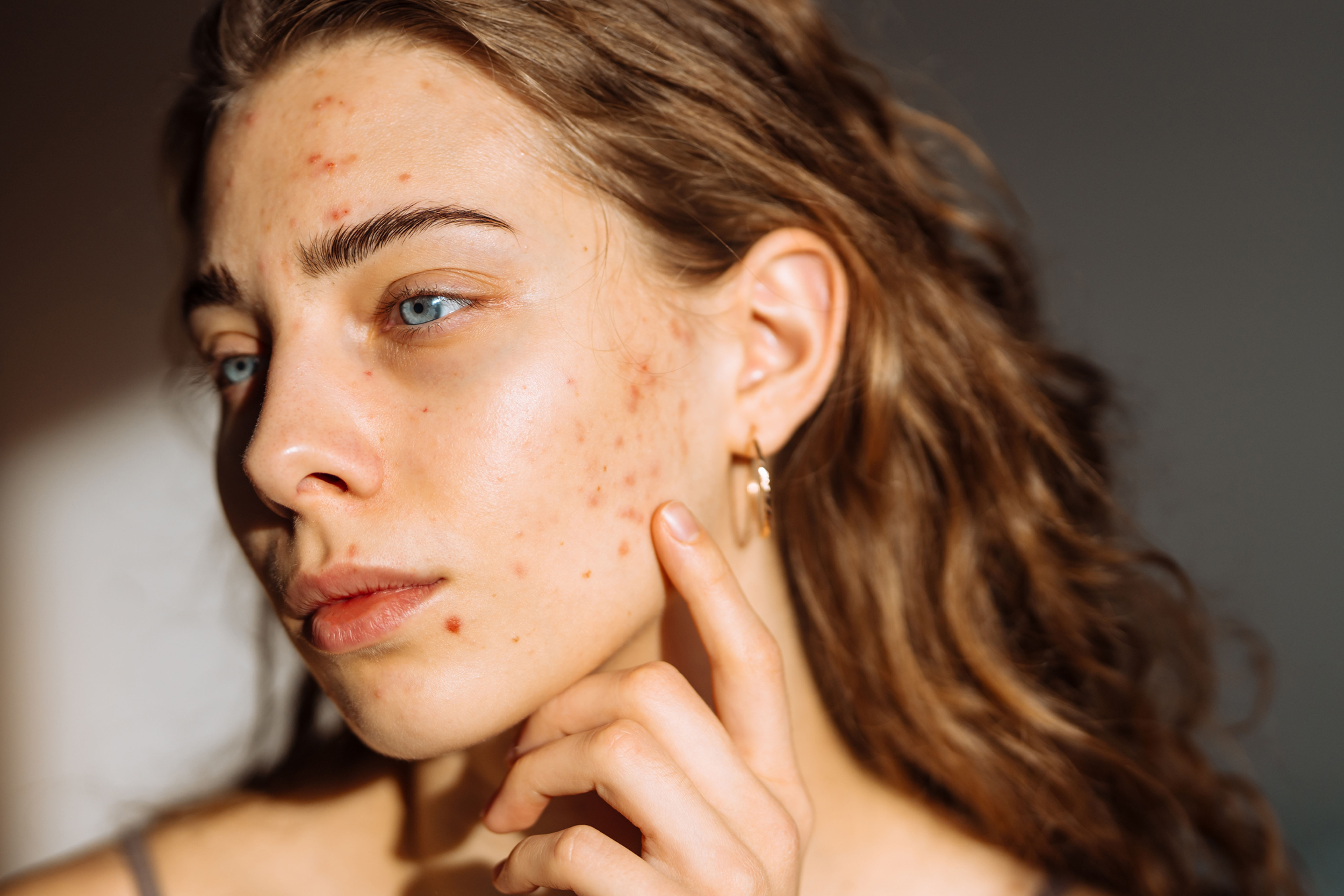 Blonde Woman with excellent skin following Exosome Treatment for skin