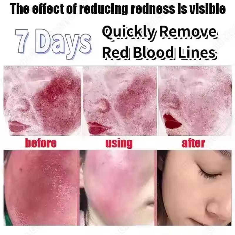 Thumbnail: Facial Redness Repair Cream Improve Sensitive Skin Dryness Moisturizer Hydrating