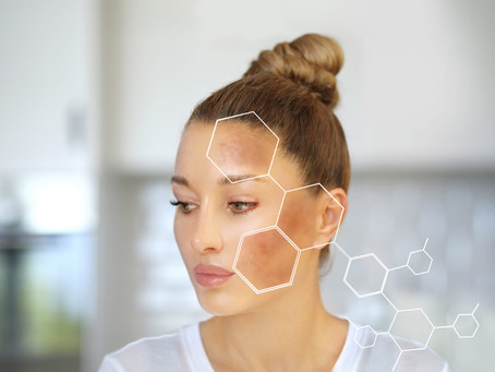 Melasma