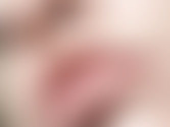 Mitos sobre preenchimento labial