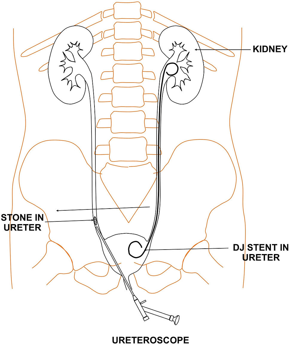 URS AND DJ STENT PLACEMENT