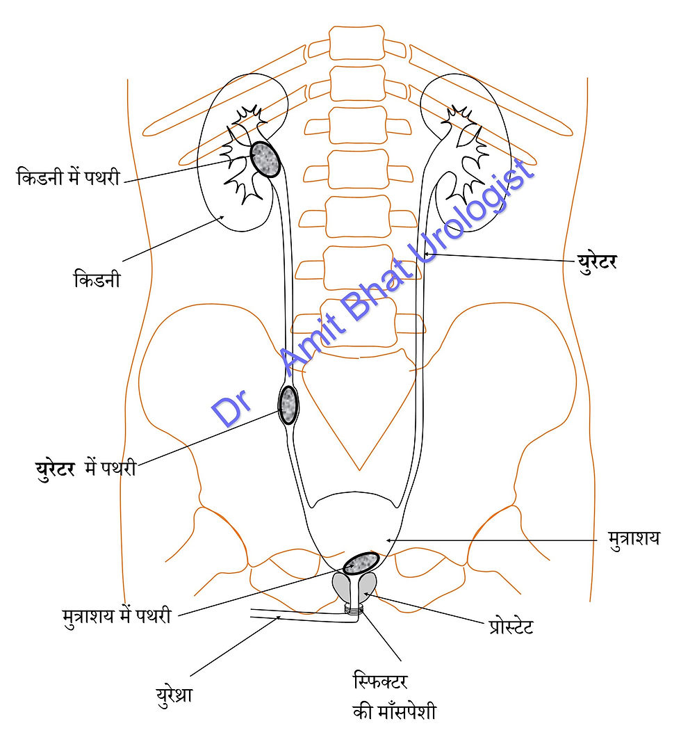 गुर्दे की पथरी / किडनी स्टोन