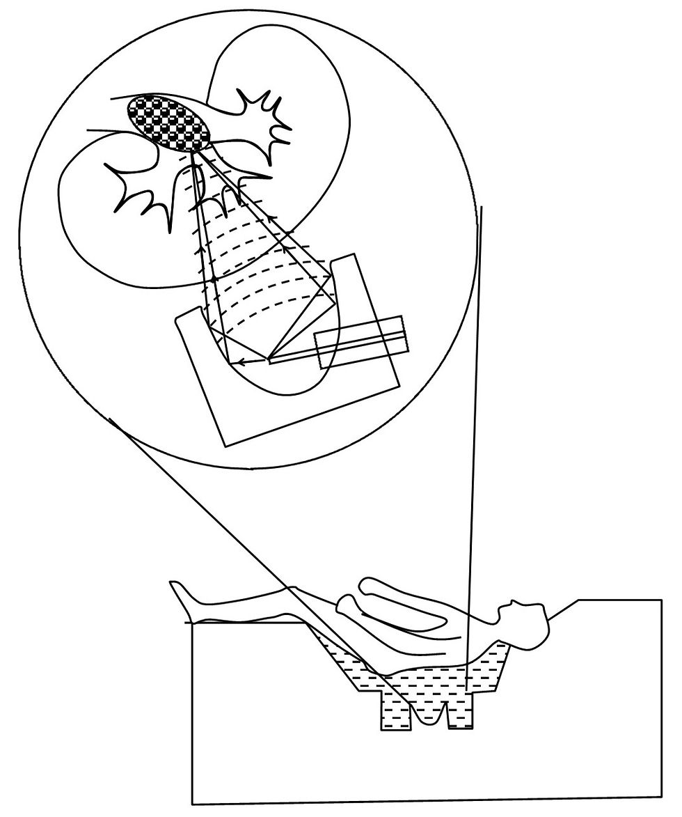 LITHOTRIPSY