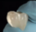 Coroa Posterior de Porcelana (e-max)