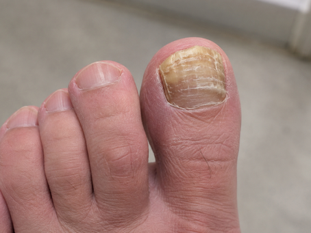 Thick Toenails: Causes, Safe Care and When to Get Help