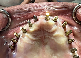 IMPLANTES DENTALES