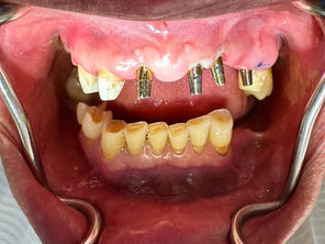 Caso Clínico: Rehabilitación Dental en Paciente Mayor de 72 años con Cardiopatía Controlada