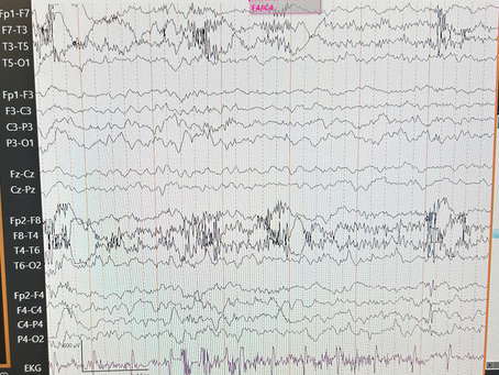 Retts syndrome peds case