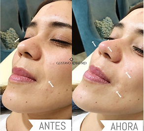 Ácido hialurónico en surcos nasolabiales