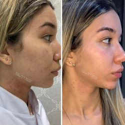 Peeling químico