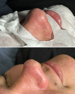 Limpeza de pele