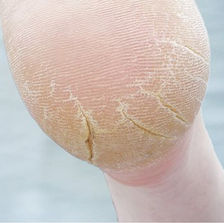 Help, ik heb kloven in mijn hielen.