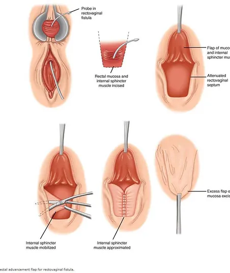 Fistola Retto Vaginale Natale Ursino